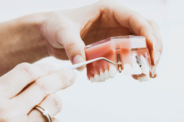 Újfajta fogimplantátumok – Tökéletes megoldás, gyulladásmentesen